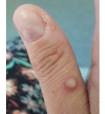 Primer caso probable de Viruela Símica en St. Louis 2