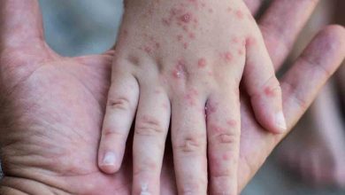 ALERTA DE SALUD: PERSONA INFECTADA CON SARAMPIÓN VISITÓ EL ACUARIO DE ST. LOUIS 15