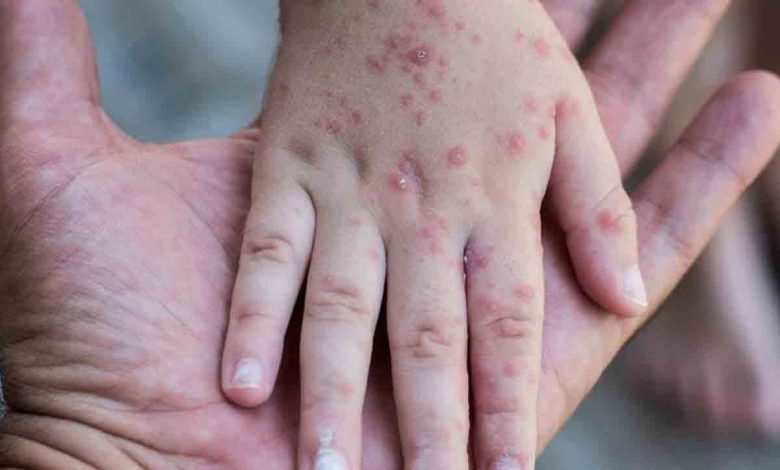 ALERTA DE SALUD: PERSONA INFECTADA CON SARAMPIÓN VISITÓ EL ACUARIO DE ST. LOUIS 1